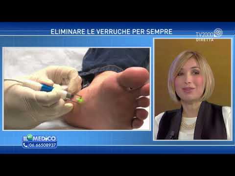 Bruciare le verruche a casa: rimedi efficaci e naturali