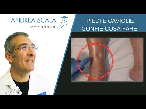 Caviglia sinistra gonfia in gravidanza