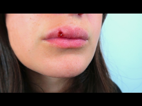 Come curare un herpes sulle labbra