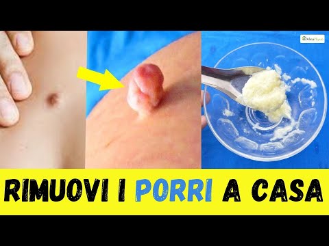 Come togliere i porri dal viso