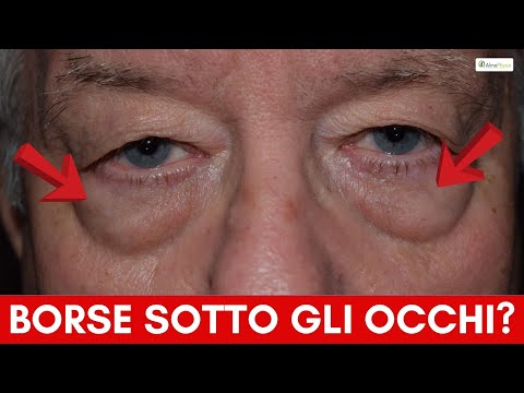 Come togliere le borse sotto gli occhi: rimedi naturali