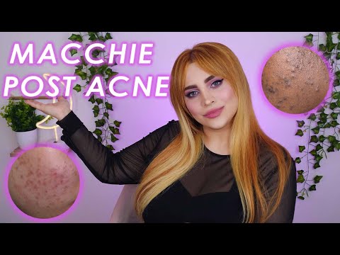 Come togliere le macchie di acne dal viso