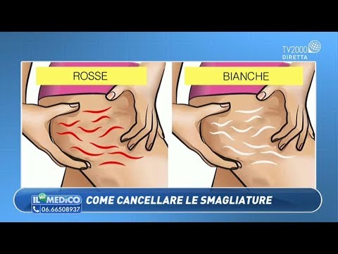 Come togliere le smagliature sul seno