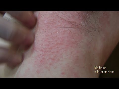 Crema cortisonica per eritema solare