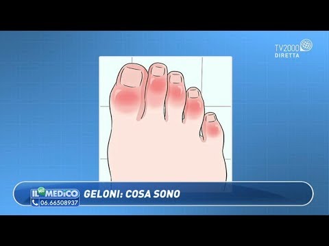 Cura per i geloni ai piedi
