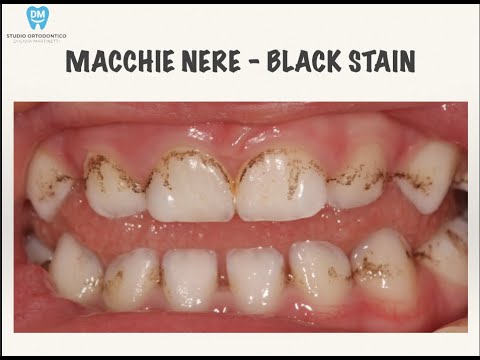 Perchè i denti diventano neri