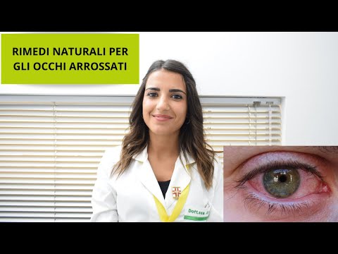Rimedi naturali bruciore occhi da saldatura