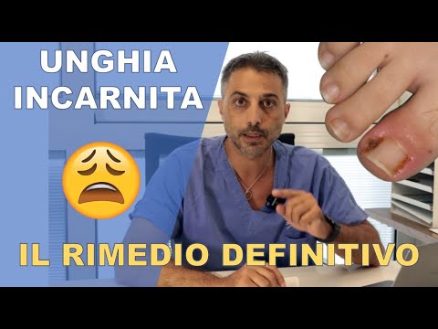 Unghia incarnita: rimedi naturali e casalinghi per prevenire e curare l'infiammazione